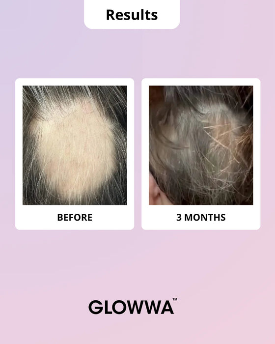Risultati prima e dopo su diradamento capelli con Glowwa Hair Food Menopause